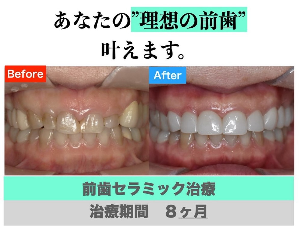 前歯セラミック治療