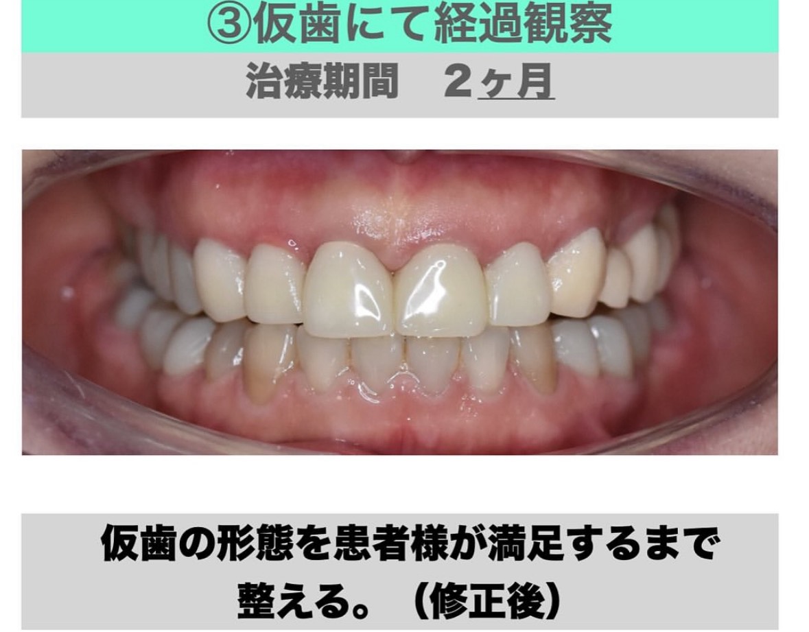 仮歯にて経過観察