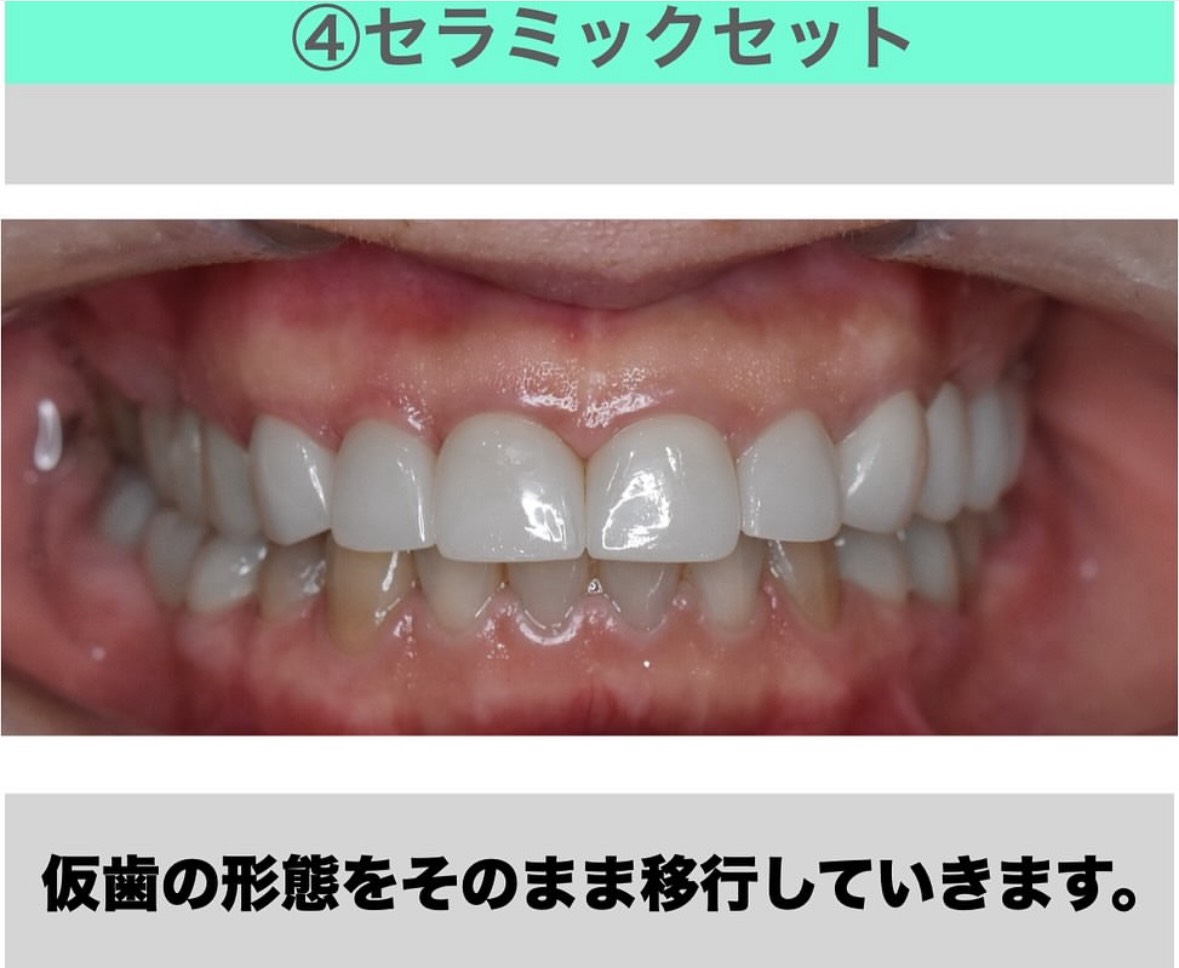 セラミックセット