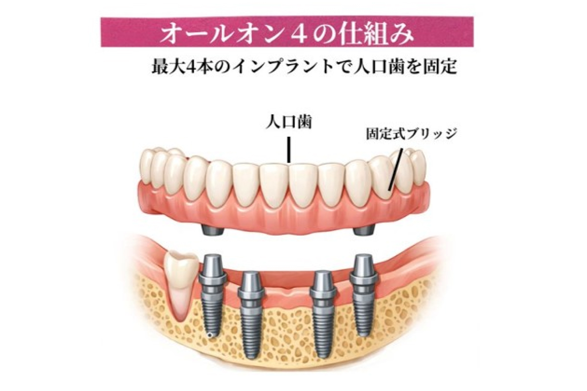 オールオン4とは？