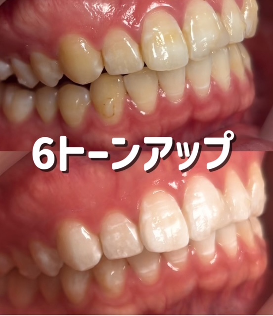 ホワイトニング症例