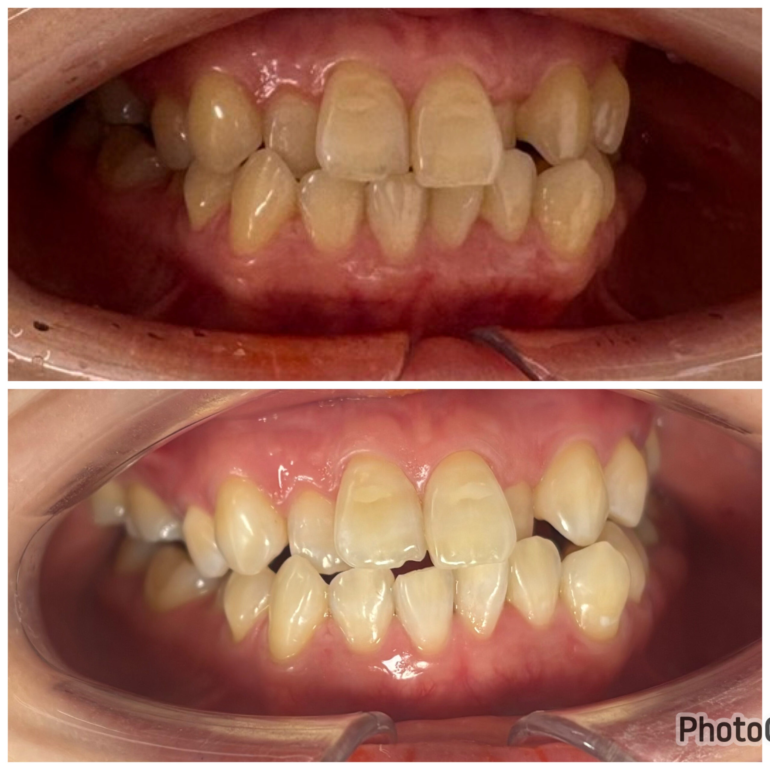 ホワイトニング症例