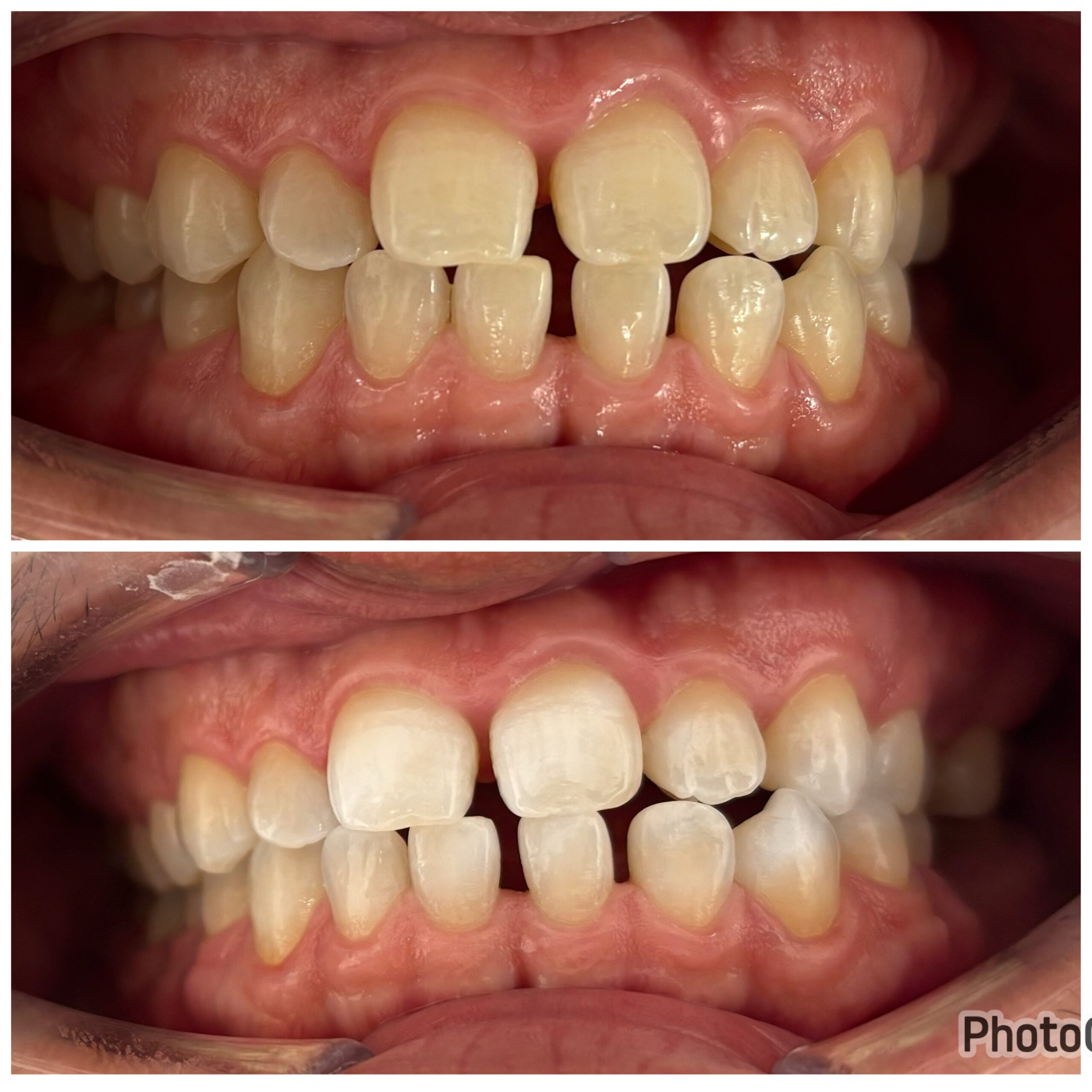 ホワイトニング症例