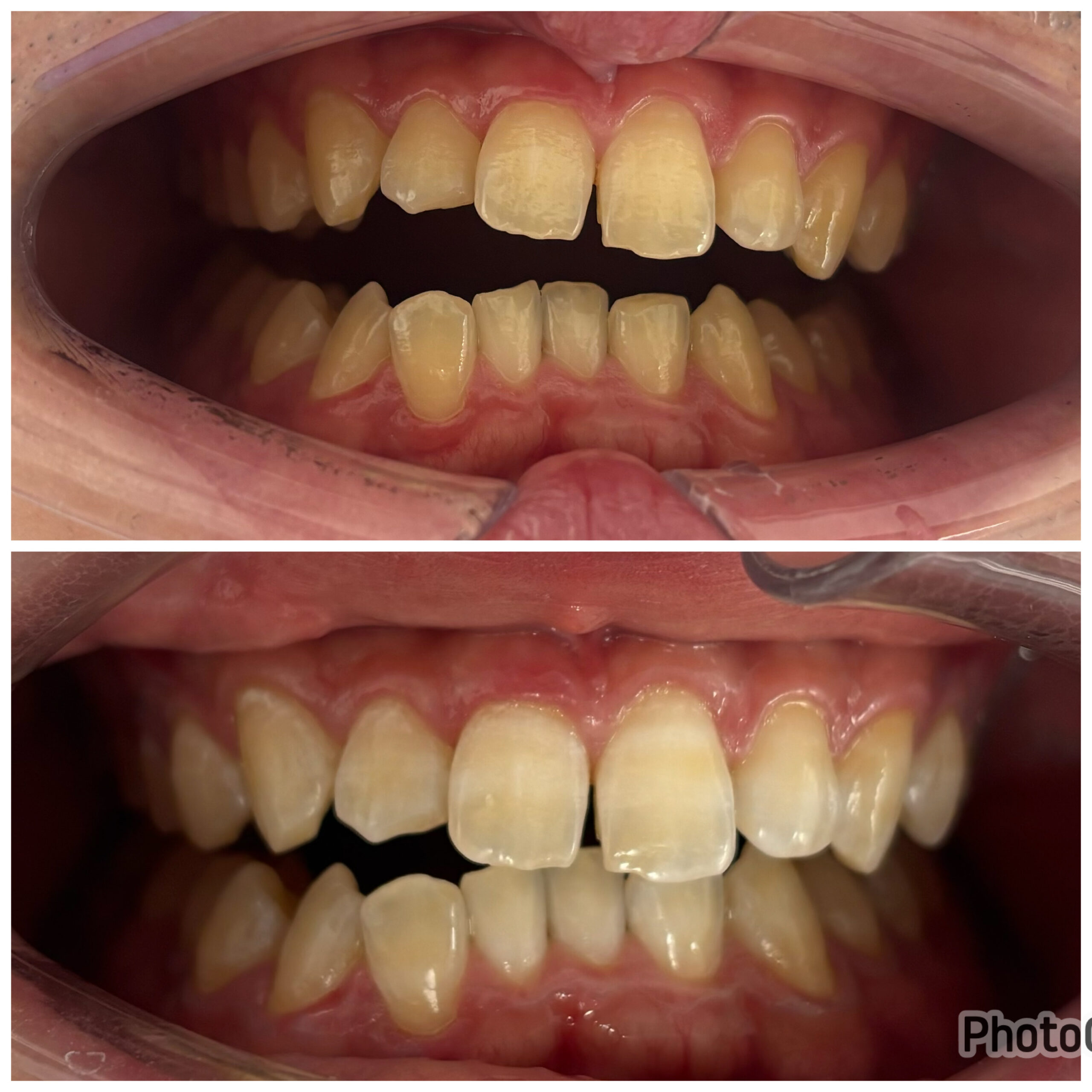 ホワイトニング症例