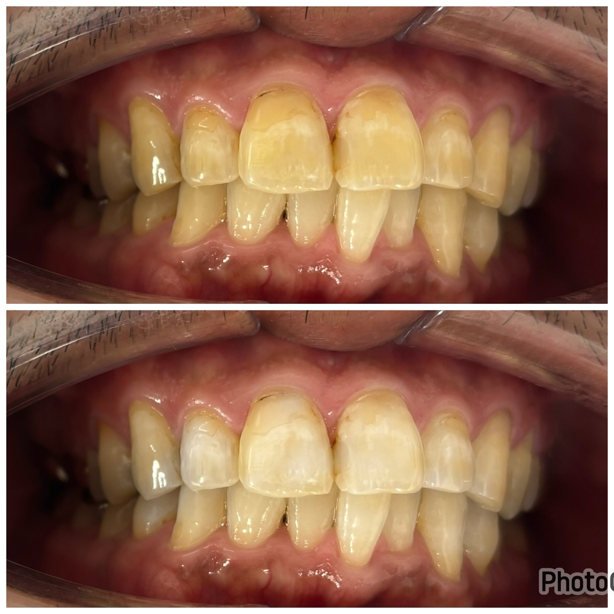 ホワイトニング症例