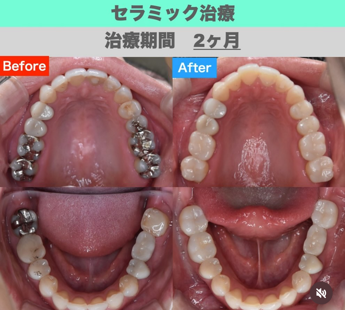 銀歯をジルコニアに治療