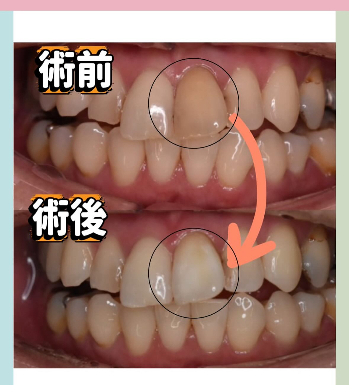 神経の無い歯の治療～ブースト～