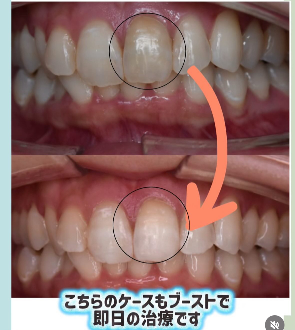神経の無い歯の治療～ブースト～