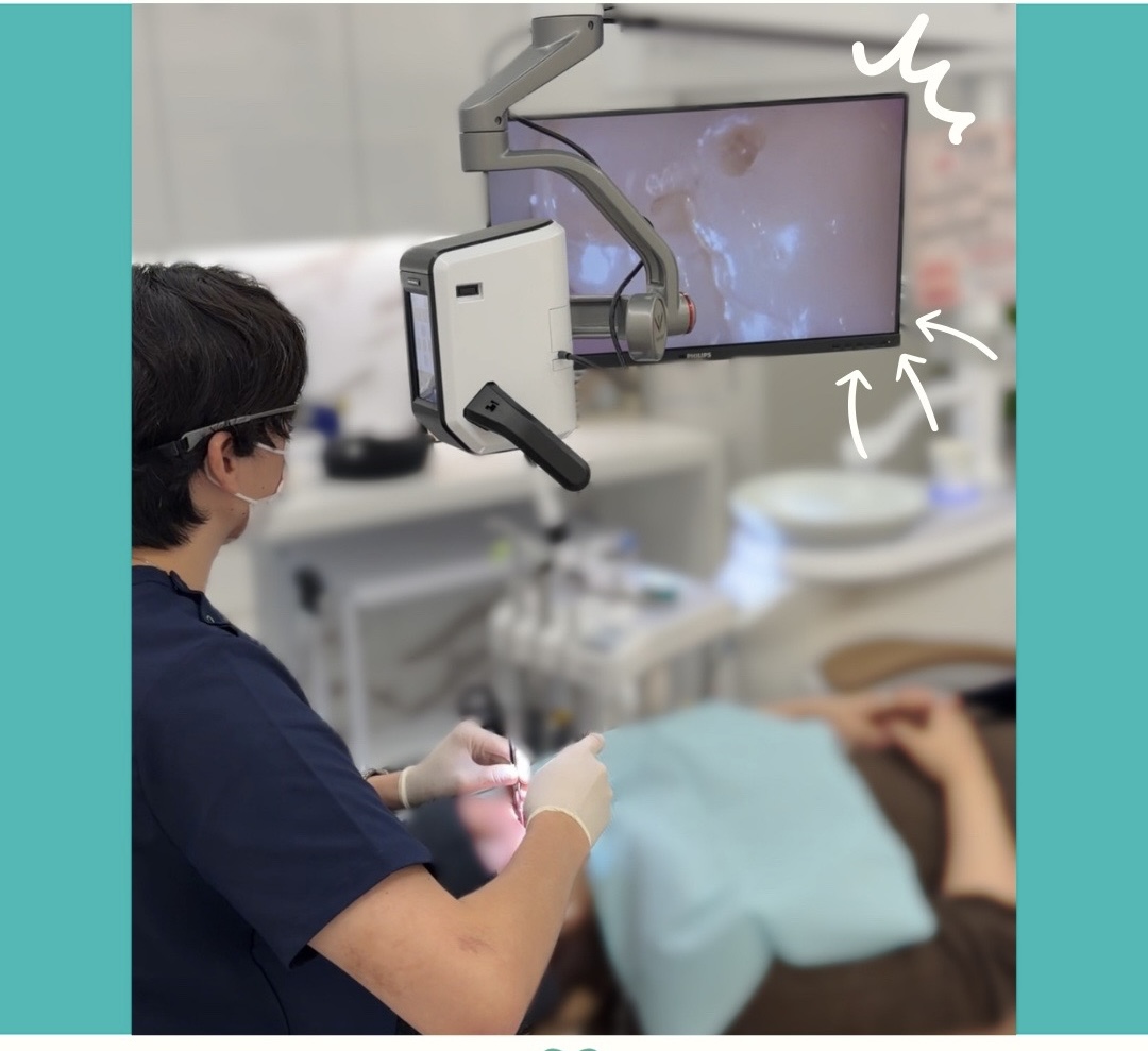 むし歯が確実に見つかる