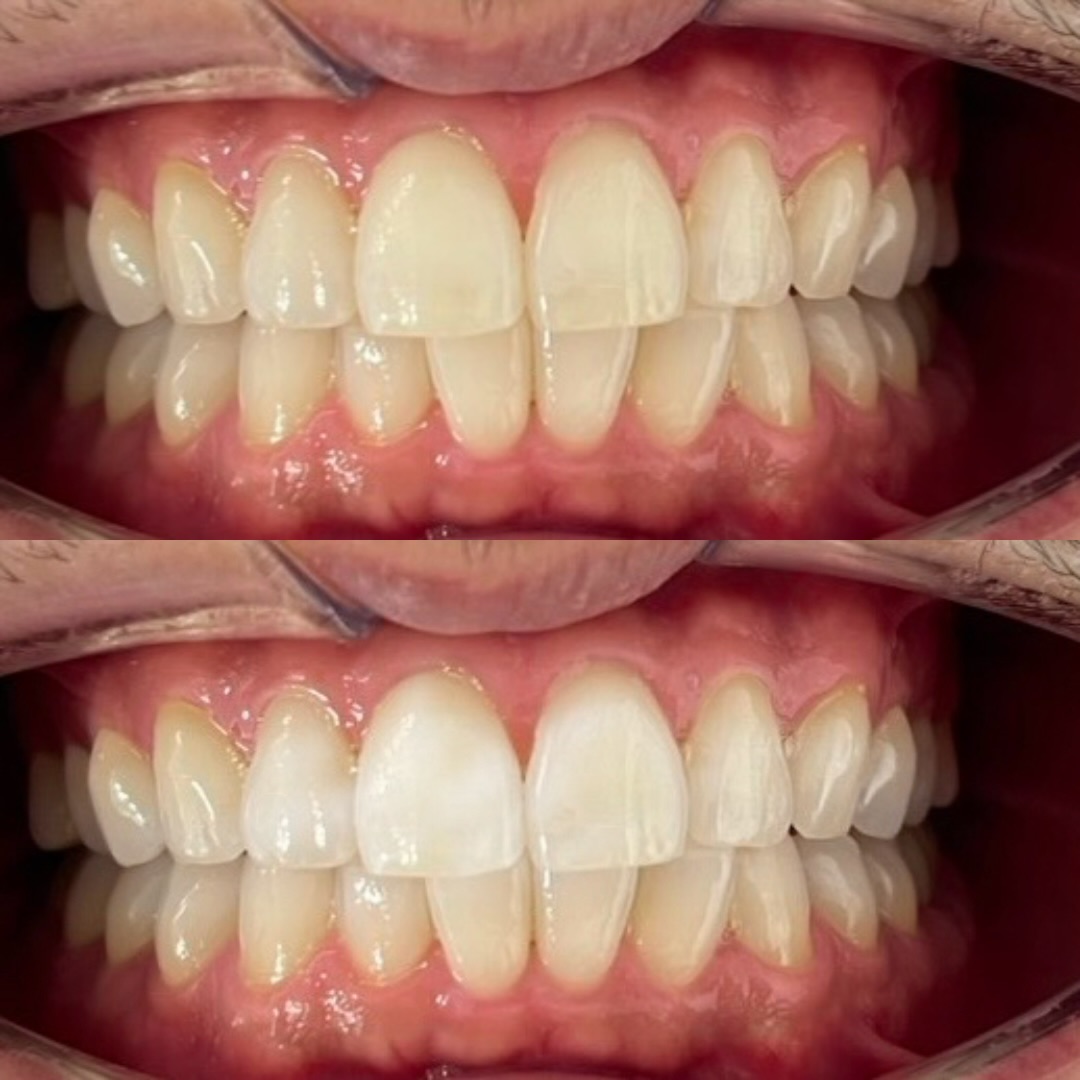 白い人が更に白くなるホワイトニング