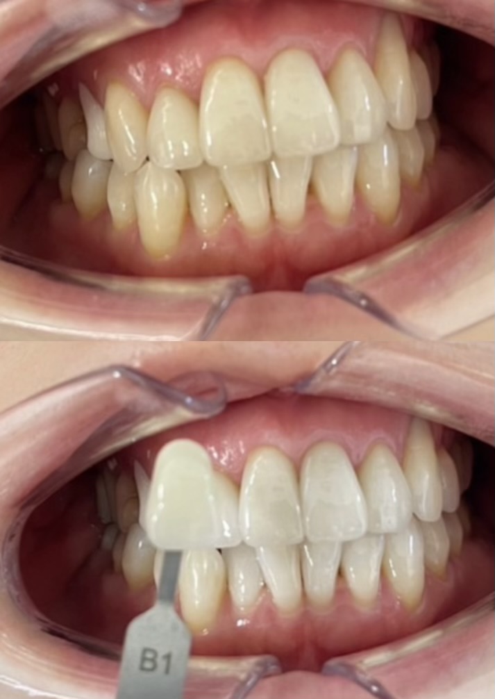 白い人が更に白くなるホワイトニング