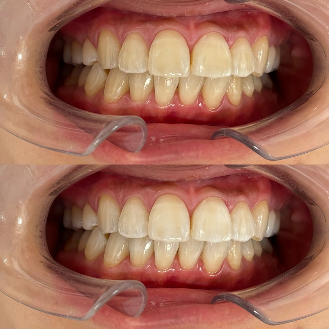 オフィスホワイトニング