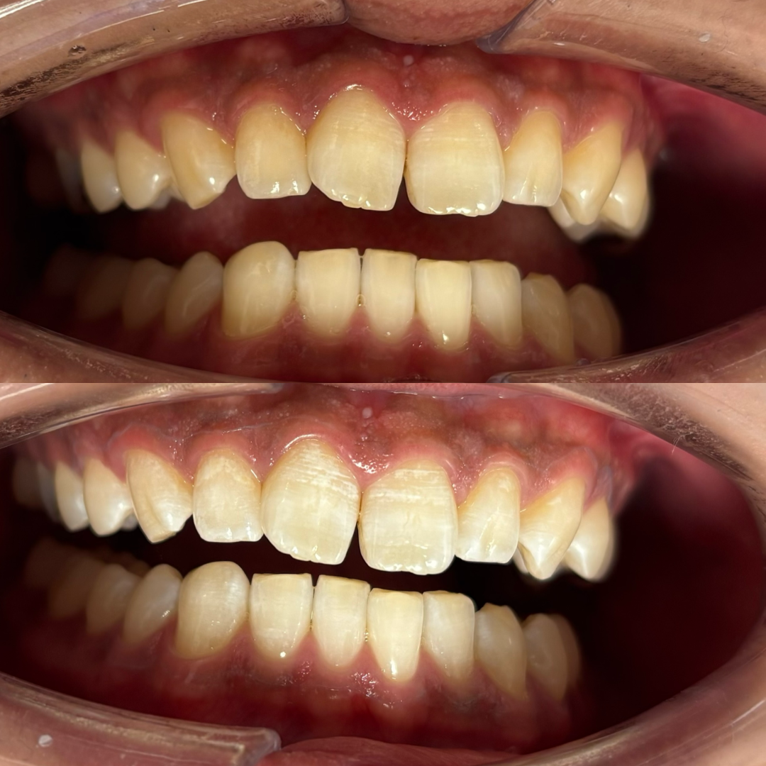 白い人が更に白くなるホワイトニング