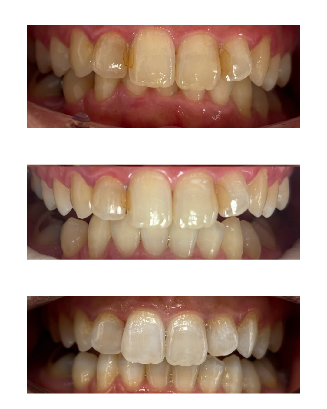 むし歯治療とオフィスホワイトニング