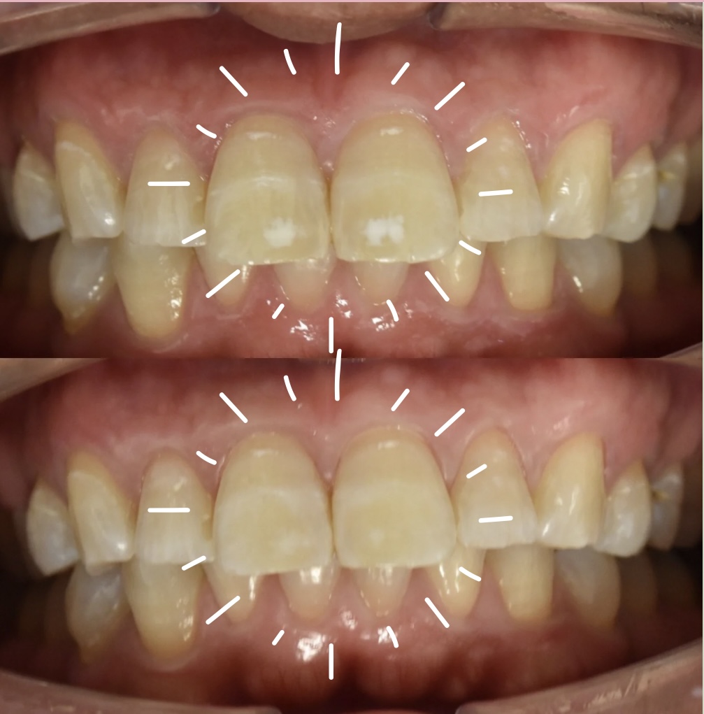 アイコン治療（ホワイトスポット）