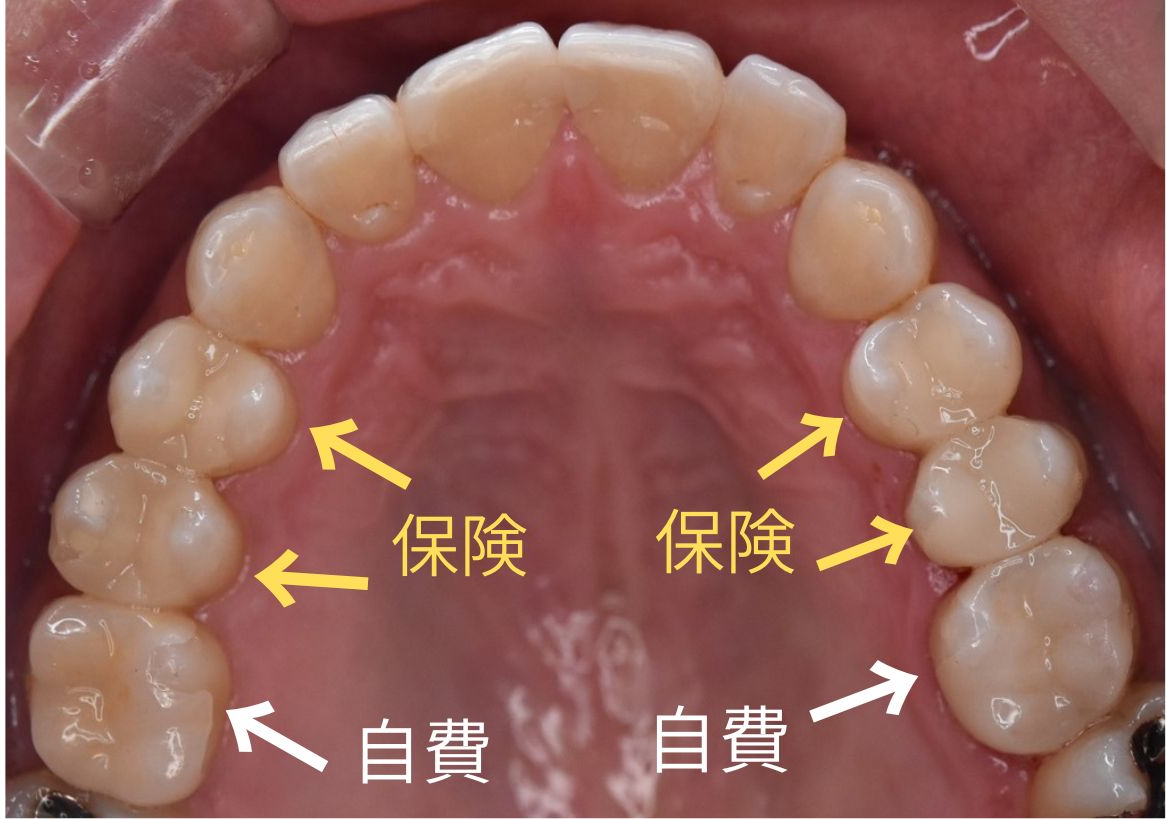 銀歯を白く（保険と自費の組み合わせ）