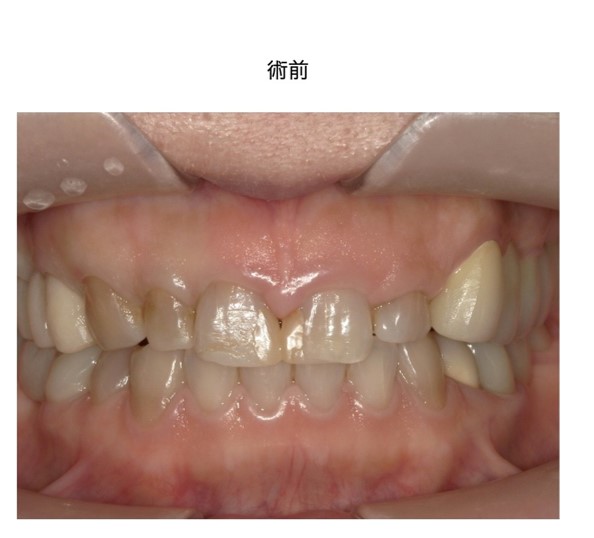 前歯のセラミックと歯ぐきのラインに違和感がある治療前の状態