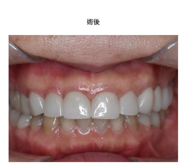 セラミック再治療で自然な前歯に仕上がった症例