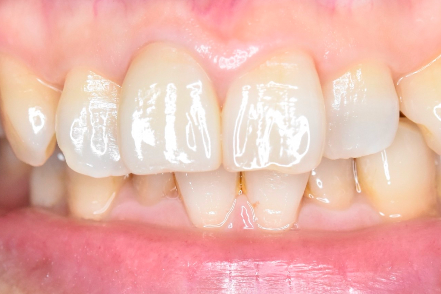 セラミッククラウンで自然な白さに改善した前歯の症例