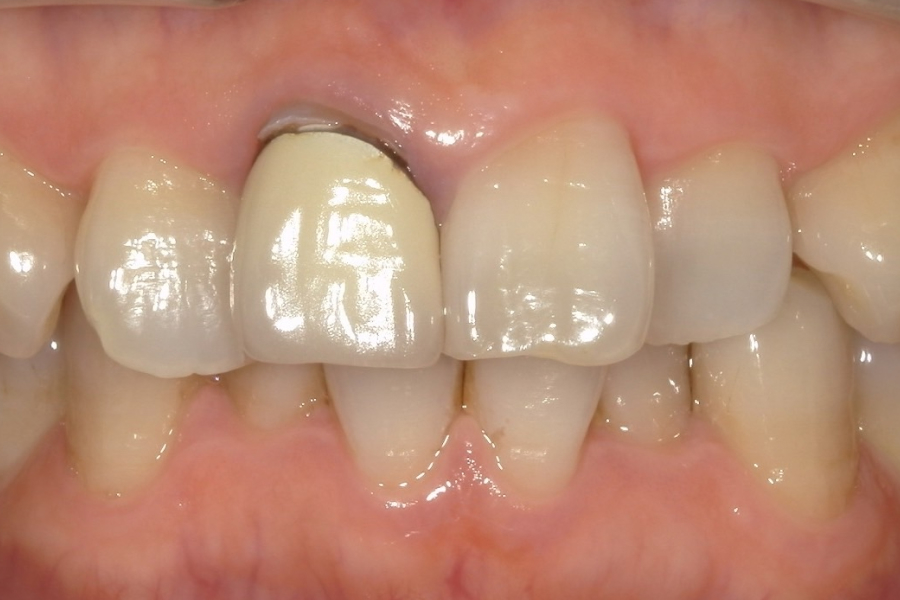 前歯の黒ずみが目立つ治療前の口元（60代女性）