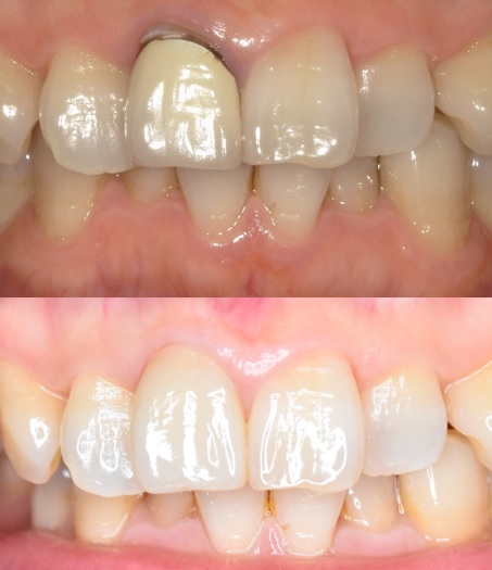 前歯が黒い原因と治療法｜根管治療＋セラミックで自然な白さに改善（60代女性症例）