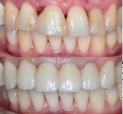 前歯の隙間が広がる原因は歯周病？再生療法とセラミックで改善した症例（40代女性）