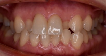 前歯2本の変色と欠けをジルコニアクラウンで自然に改善した50代女性の症例