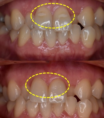 前歯の変色を繰り返す方へ｜ジルコニアクラウンで自然な仕上がりに改善した症例