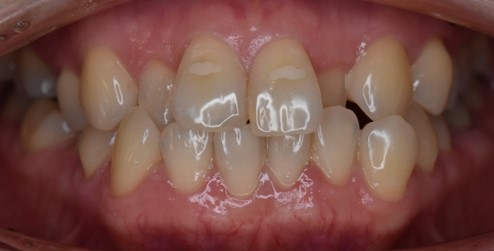 前歯2本の変色と欠けている50代女性の症例