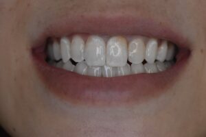 前歯のCR（コンポジットレジン）劣化による変色をやりかえで改善した症例のアフター