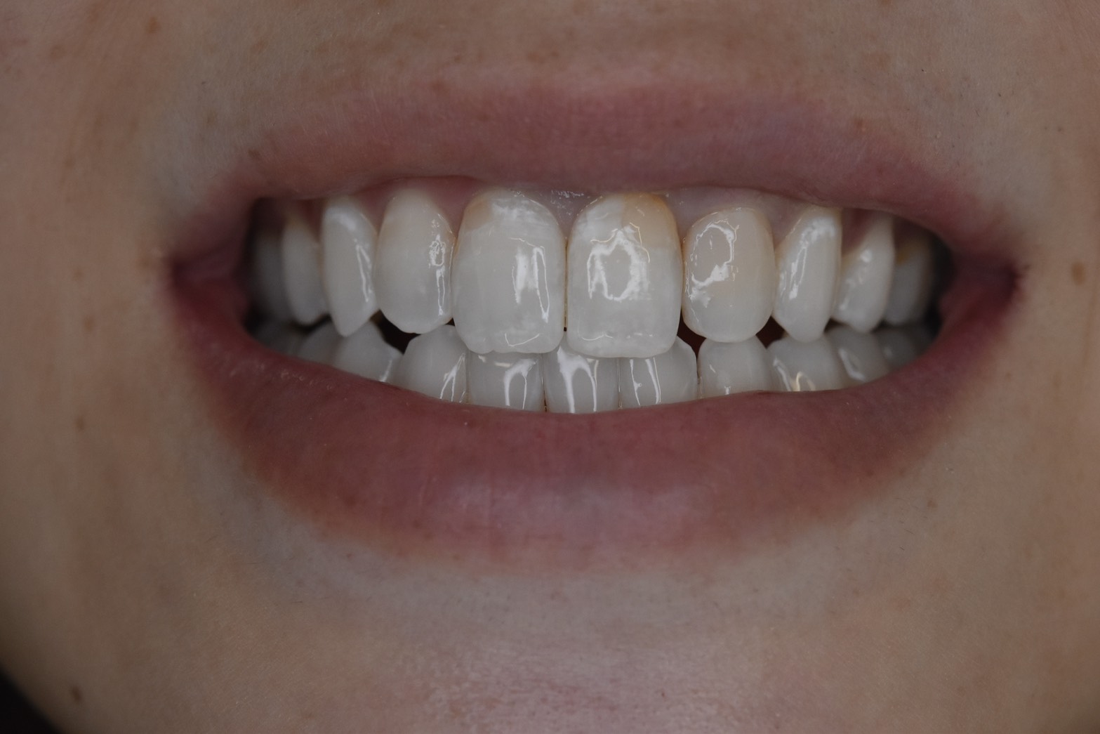 前歯のCR（コンポジットレジン）劣化による変色をやりかえで改善した症例のアフター