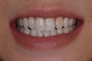 前歯のCR（コンポジットレジン）劣化による変色をやりかえで改善した症例のビフォー