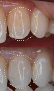 前歯のCR（コンポジットレジン）劣化による変色をやりかえで改善した症例のビフォーアフター