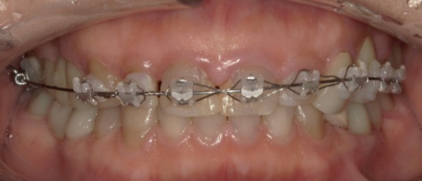 40代女性の矯正治療中の歯並びの状態（大阪北新地）