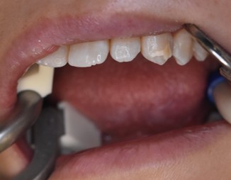 アイコン治療とダイレクトボンディングを併用したケース治療前