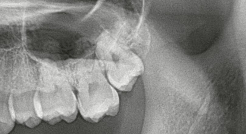 【親知らず抜歯症例】根が二股に分かれた親知らず｜抜歯が難しいと予想されたケース
