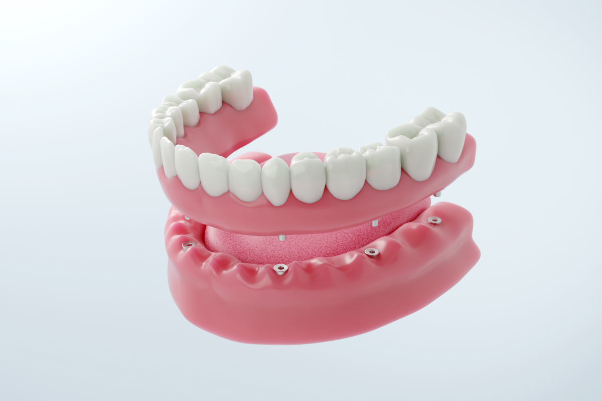 インプラントオーバーデンチャーとは？