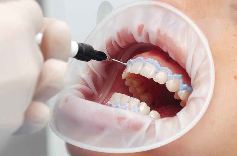 歯肉保護剤塗布