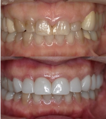 セラミック治療後の歯の形と歯ぐきの高さを改善｜40代女性の症例