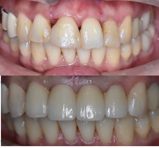 前歯が開いてきた原因は歯周病｜再生療法とセラミックで改善（40代女性）