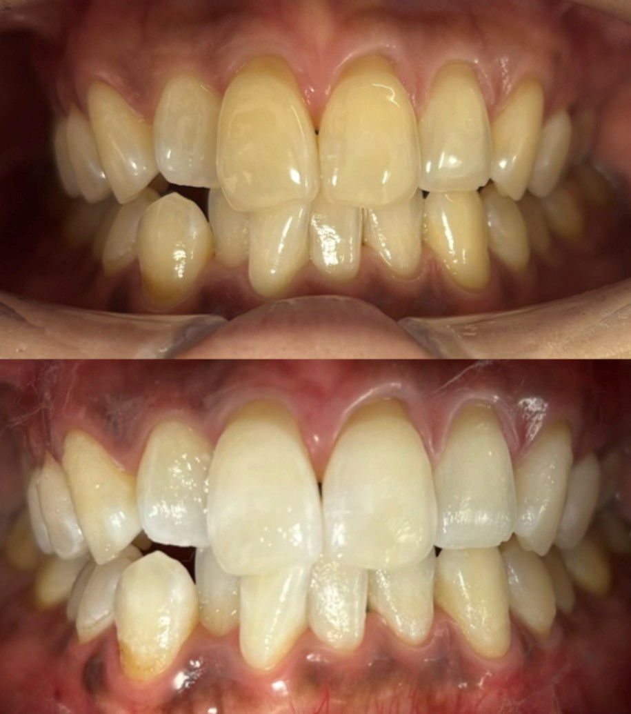 白い歯をさらに白く｜ホワイトニング経験者の30代女性