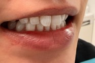 ホワイトニングリタッチで白い歯をキープ｜20代男性の症例