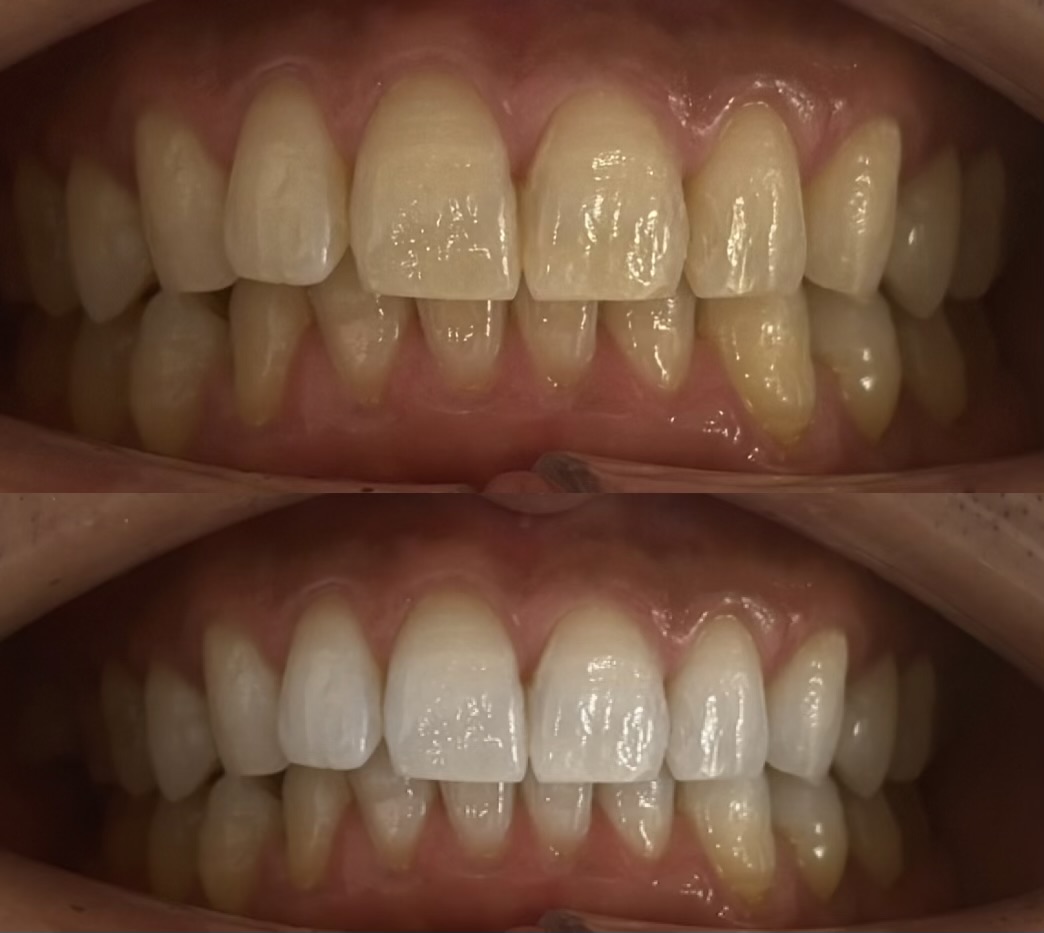 ホワイトニングリタッチ