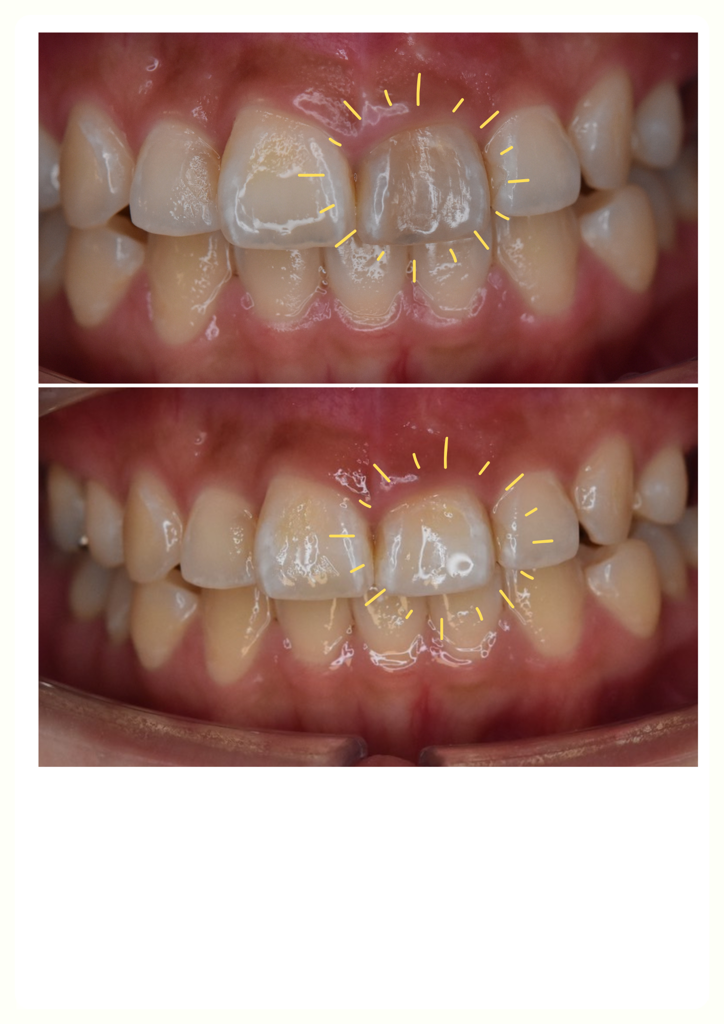 神経の無い歯の治療