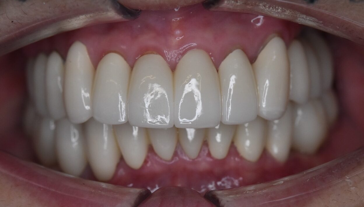 60代女性審美治療後の写真正面