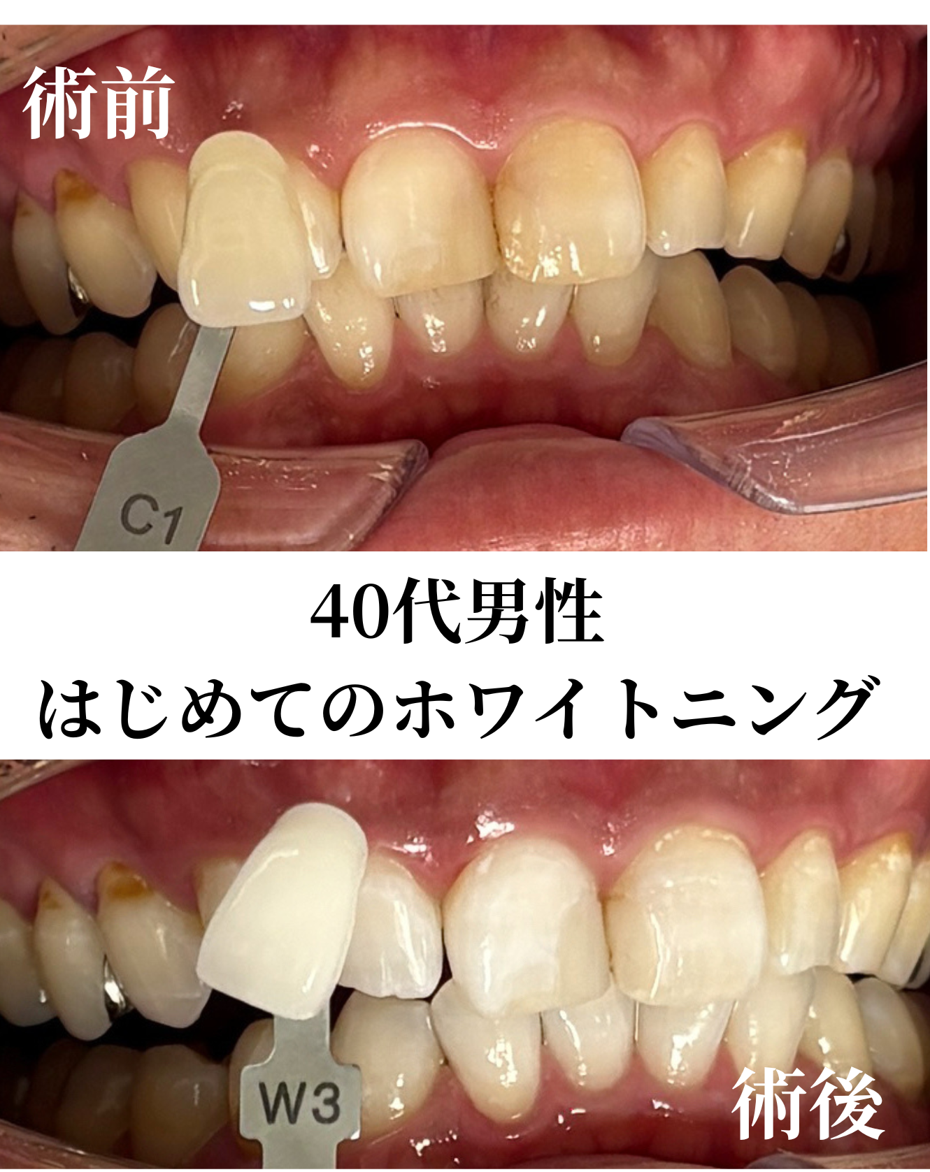 初めてのホワイトニング｜40代男性の症例