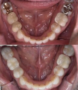 銀歯をジルコニア治療に変えた口腔内の様子