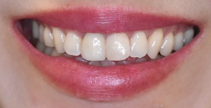 セラミッククラウンで前歯の見た目を改善した症例