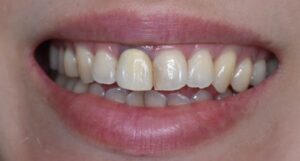 古い前歯の差し歯で歯ぐきが黒く見える症例