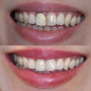 セラミッククラウンで前歯の見た目を改善した症例